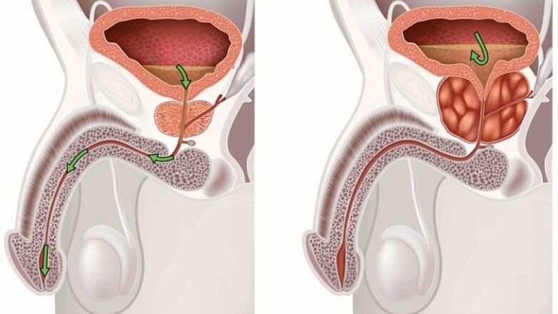 Stagnation des Urins bei Prostatitis